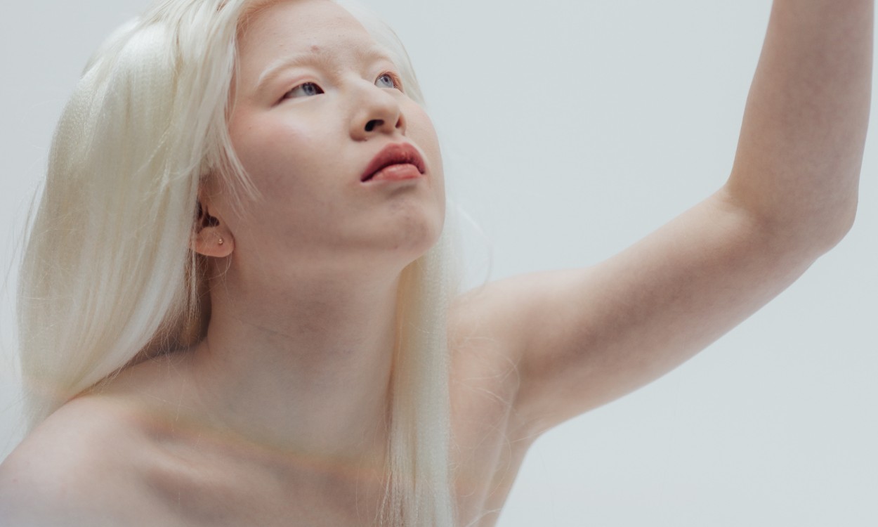 Door Xueli haar albinisme werd ze door haar biologische ouders te vondeling gelegd in China; ‘Ik zou tegen ze zeggen dat ik van ze houd en de keuze begrijp’